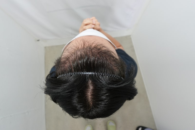 자라다의원 1699모낭 비절개 4개월 후기