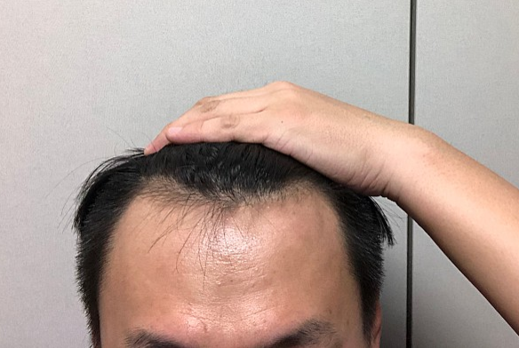 비포포포.PNG