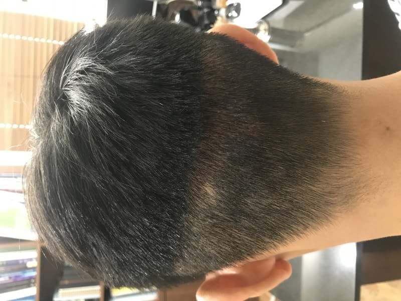 2nd week of hair transplant! After removing the scab..