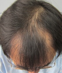 I got a second operation for a nasal incision Parental hair transplant 2544 hair follicles