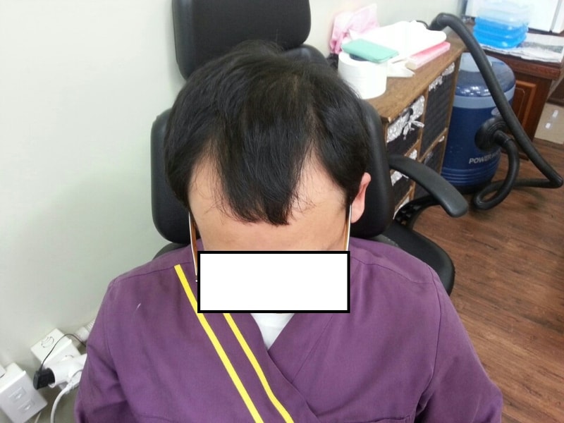 非切開 1950毛包 1ヵ月後記