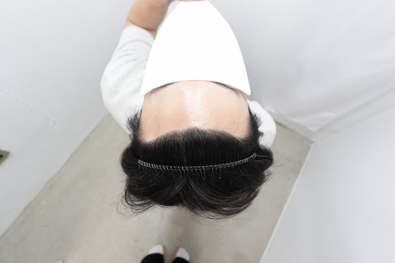 [자라다 의원] 수술 8개월 차 후기