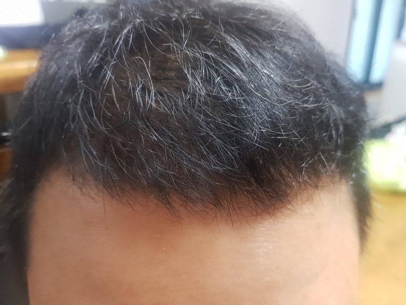 모발이식 9개월차 후기 입니다.