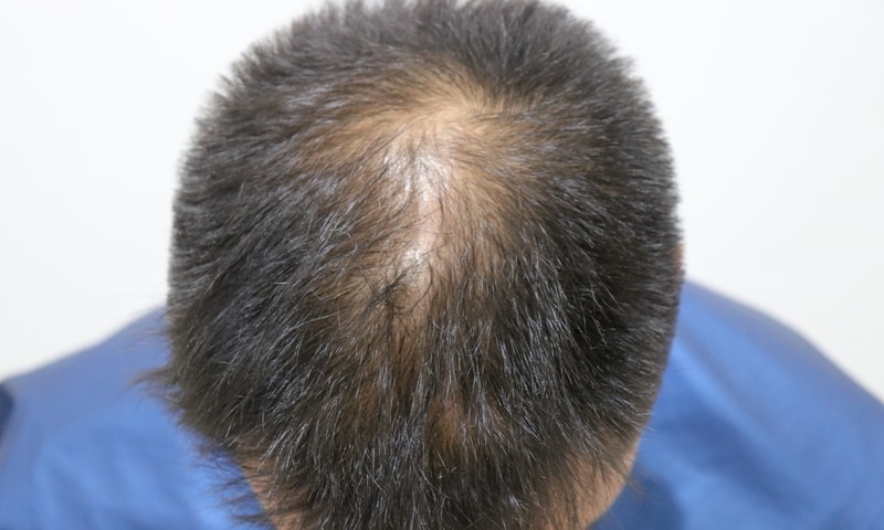 No cut hair transplant top of the head for 9 months