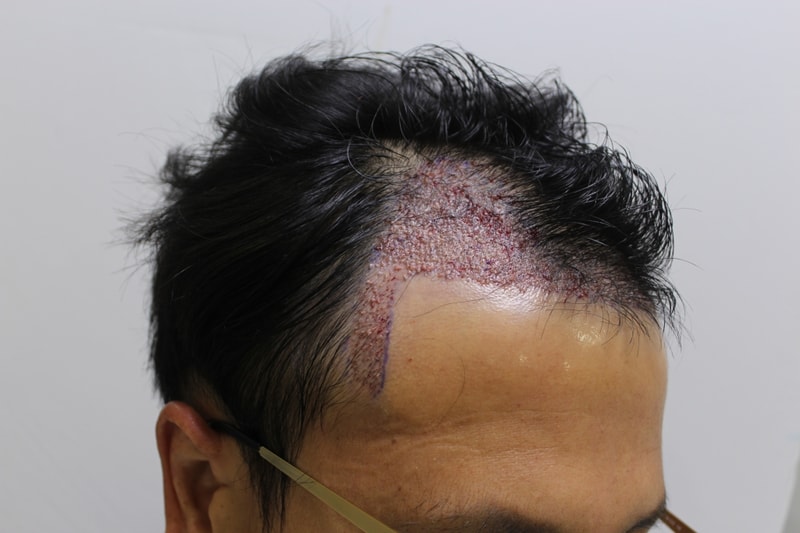 C2G Vibal 1800 Hair follicle review [Four Hair Daegu Branch]