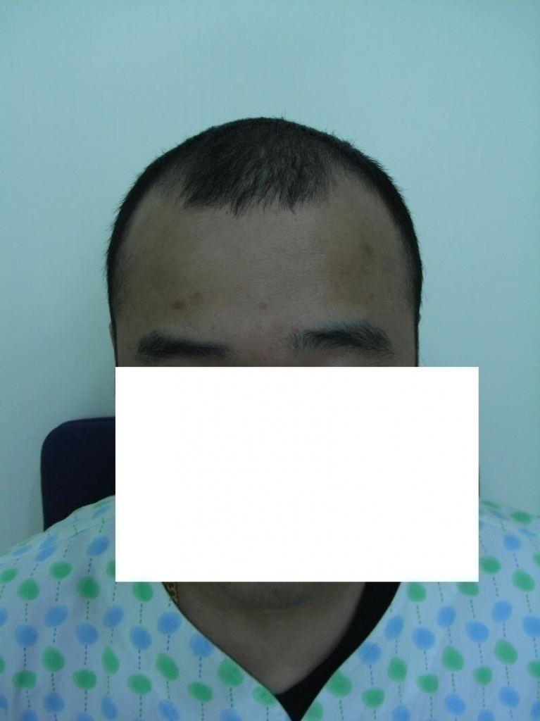 수술전정면.JPG