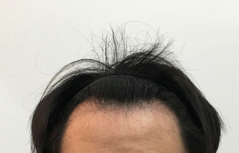 모플러스 비절개 약 1개월 차