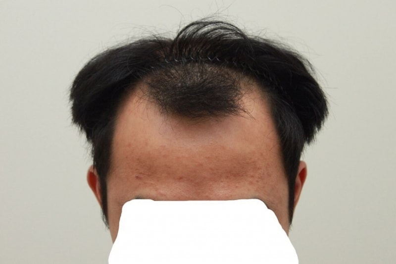 이식전1.jpg