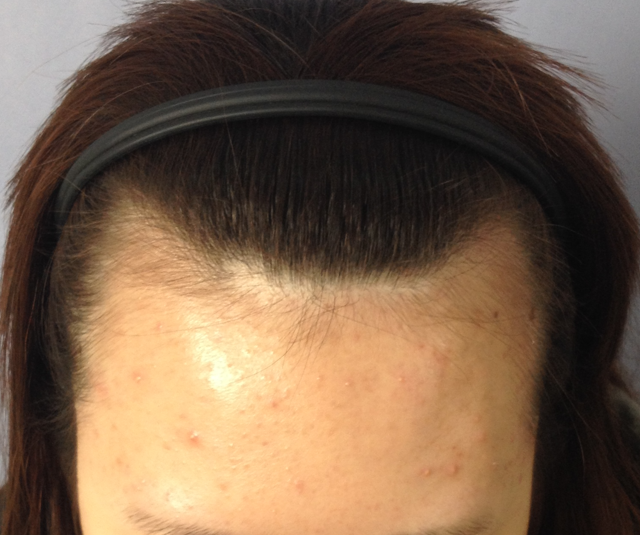 : M자 + 비대칭 교정 모발이식 1년차 결과 공유해요