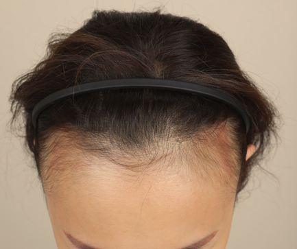 ヘアライン2週目、簡単にレビューを書いてみます