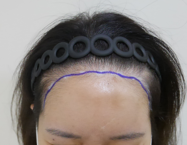 ヘアライン矯正1年目のレビュー