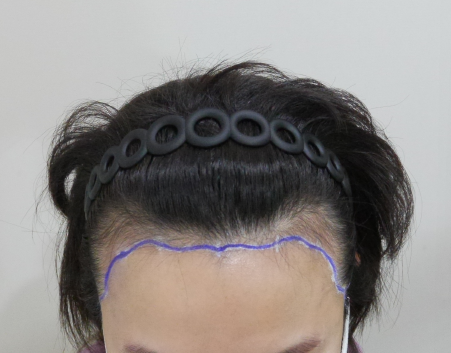 ヘアライン矯正1年目のレビュー