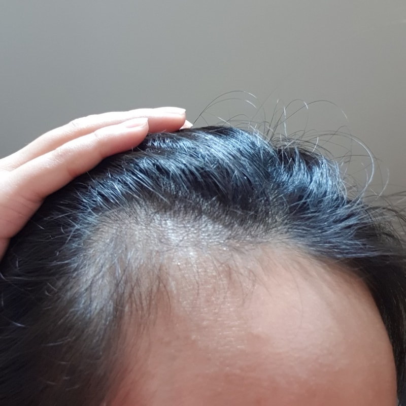 发际线1年后期~~