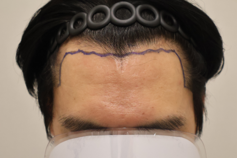 [ドンタンヘアロ医院]、[2週目]、[毛髪移植] レビューです。 最高に満足しています。