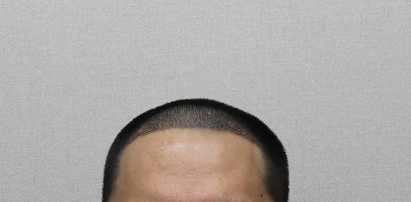 [moplus整形外科] 4000 毛发移植后期