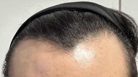 [MOPLUS 整形外科] 非接缝 毛发移植 3000根