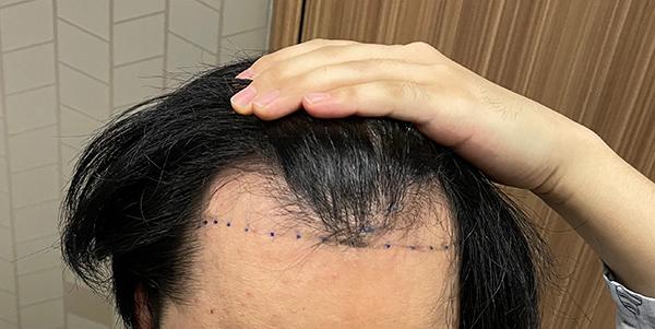Morplus Plastic Surgery Nonsetectomy 3,300 Mo 6 Months Late Review