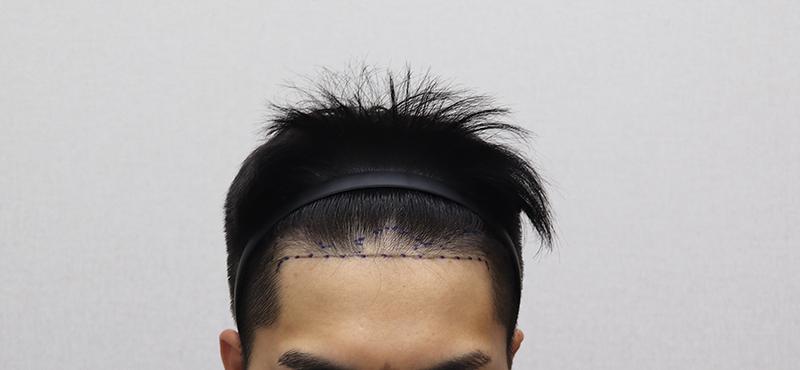 It's been 6 months since the MoPlus hair transplant!