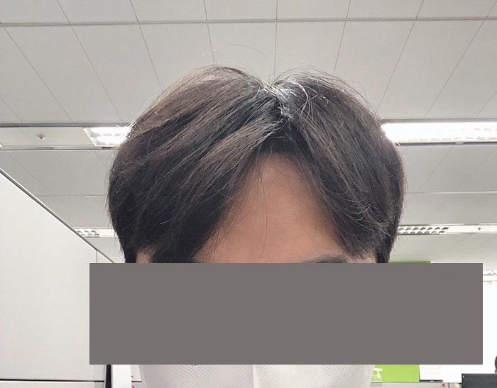 4시술후 2일차.jpg