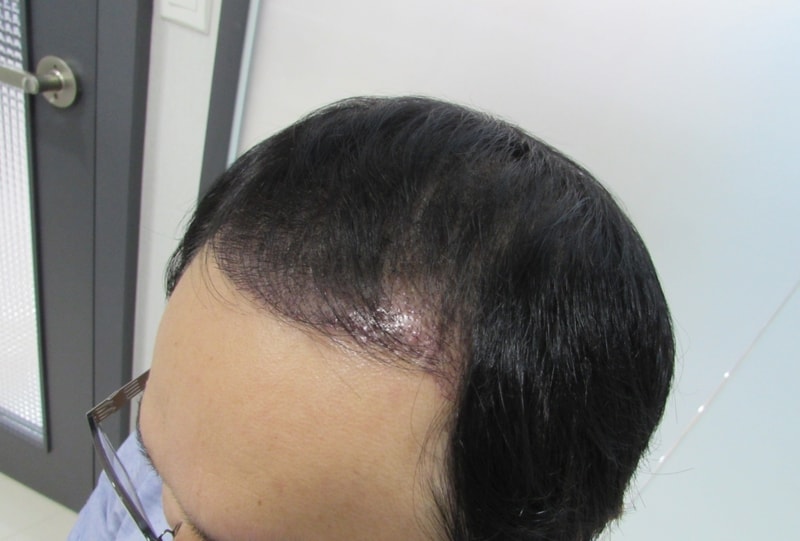 수술후2주_1.jpg
