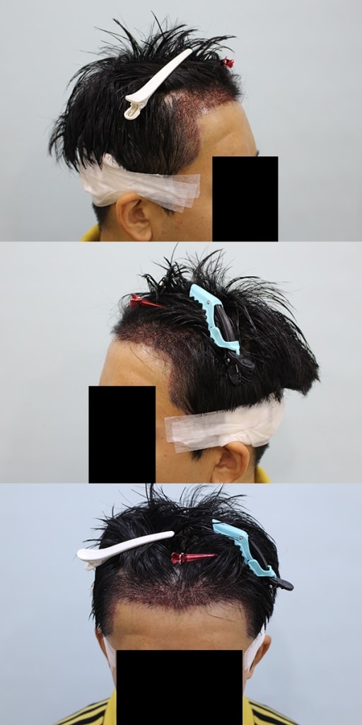 수술후.jpg