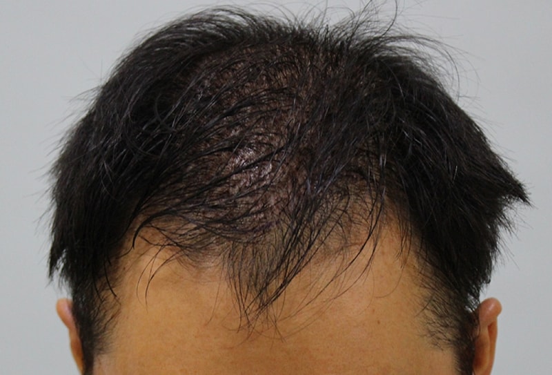 수술후1일째(3).JPG