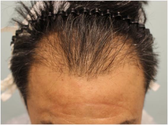 1 year of hair transplantation for the crown of middle age hair, 4500 non-intersected, Dr. Charm, Kim Ju-yong