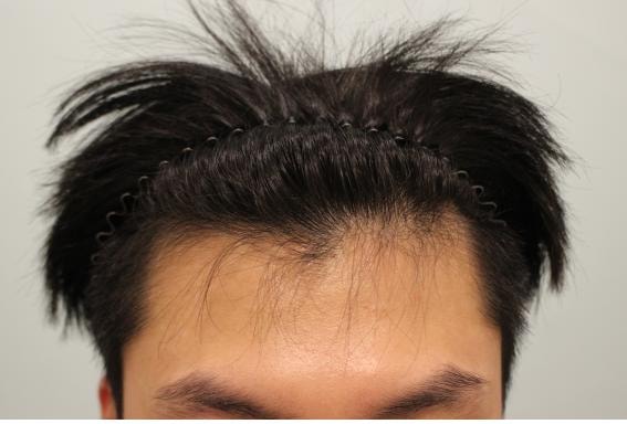 Hairline + top repair costal incision 3500 m.o. I came for 8 months