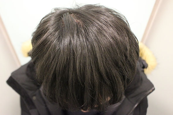 수술후 1년1개월 7.JPG