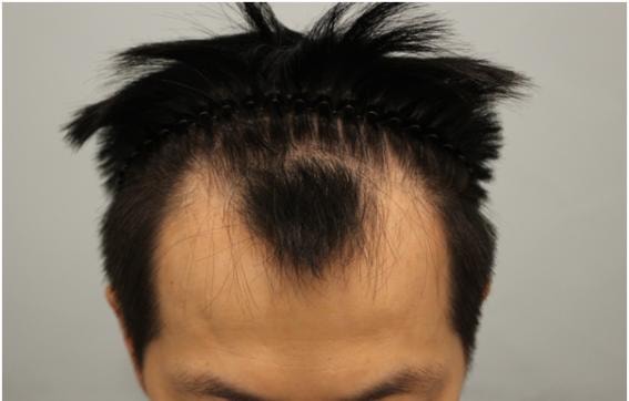 术后1年。 M字，是头顶植发效果。