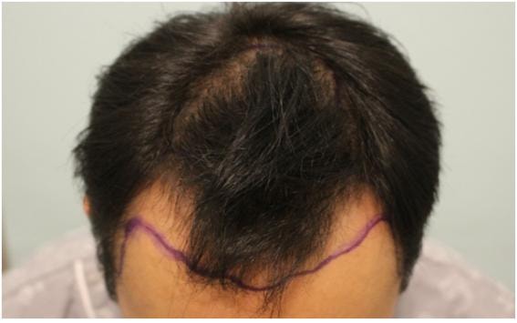 Wide M-shape, hair transplant to the top of the head (non-intersected 4500)