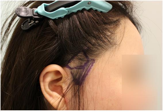 6 months of scalp scar on the side of the head