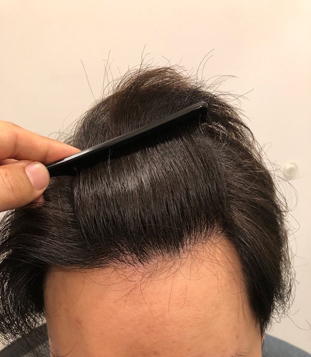 Non-cut 2400 m-shaped hair loss hairline transplant 15 months evaluation