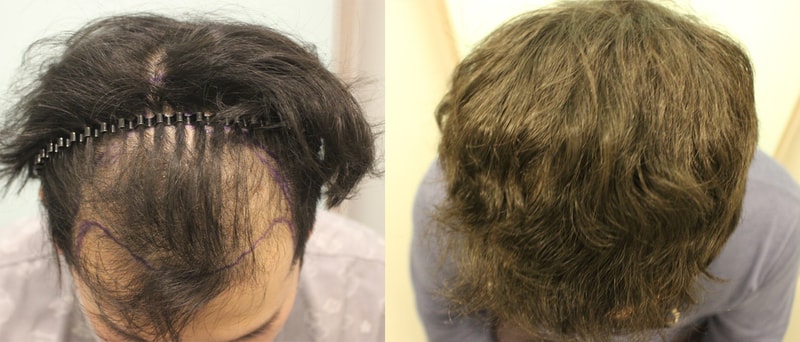 A severe M shape to the middle of the top of the head, a simple comparison before and after a year