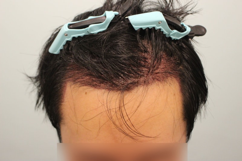 수술후 1일 2.jpg