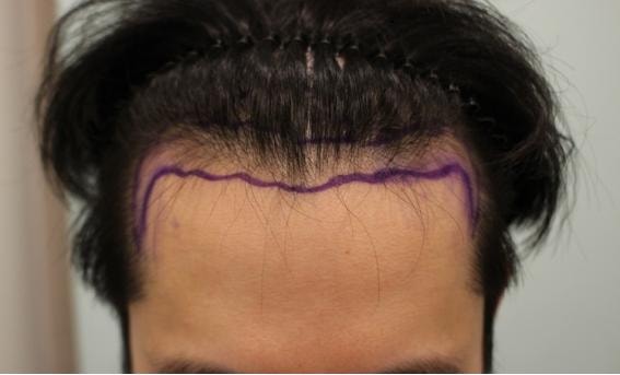 ヘアライン矯正、髪の毛の下の写真、切開3000、半年、チャムドクター医院、キム·ジュヨン院長