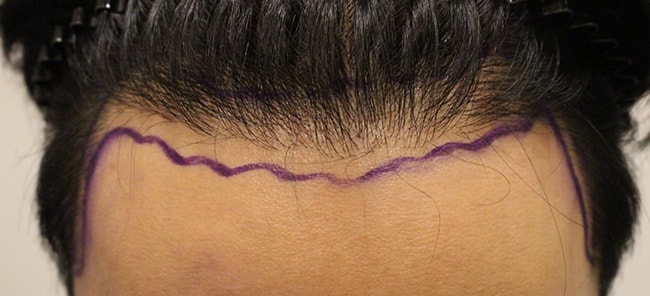 m-shaped hair lossless foot incision 2nd, 3,000 hats over 2 months~