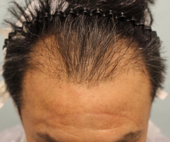 Middle-aged hair loss in 40s 8 months, non-cut 4500