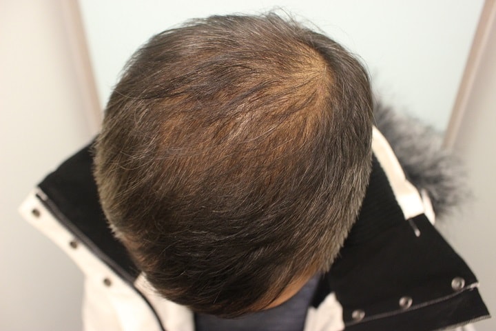 2. 수술후3달.jpg