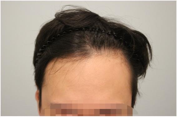 M-shaped hairline unshaved 3800 hair transplant, 2 months