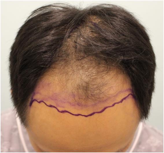 1 year, total crown hair loss <non-cut 4500>
