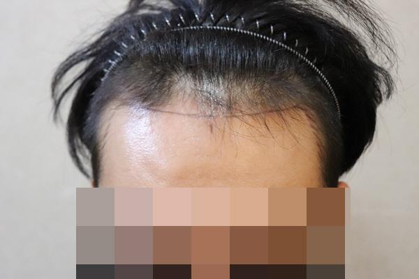 제이피성형외과 비절개 모발이식 14일차까지 후기