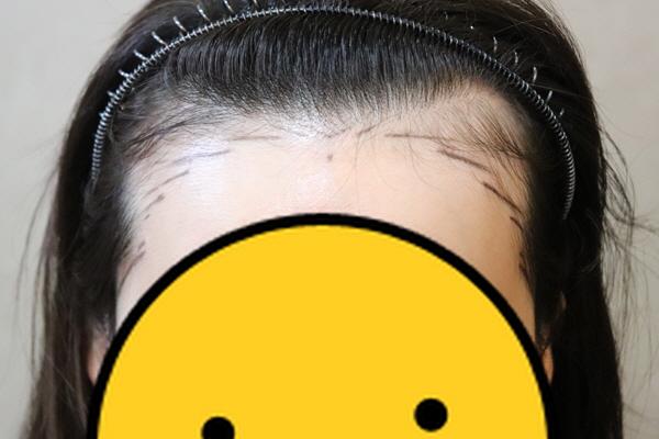 jp성형외과에서 절개 헤어라인 2주차 후기