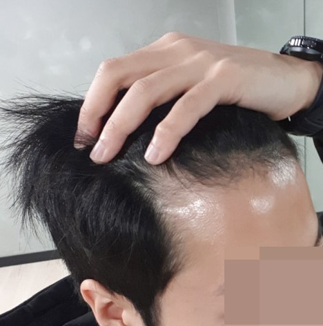 m-shaped non-cut 2000 Mo 7 months evaluation