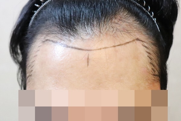 제이피성형외과 14일차 벌써 자연스러운 느낌이네요