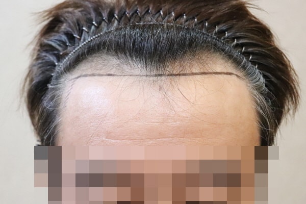 제이피성형외과 비절개 14일 후기
