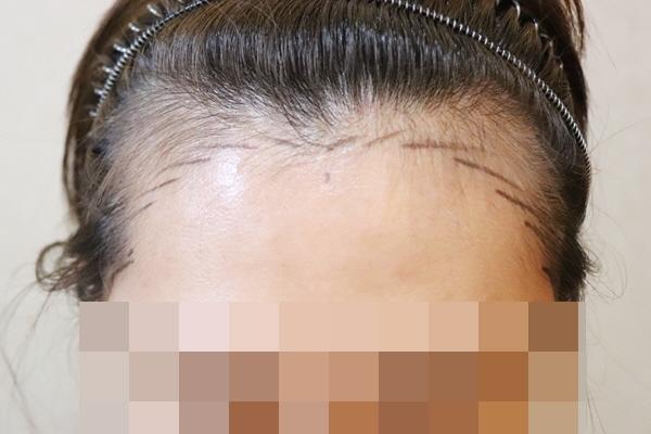 제이피성형외과 헤어라인 2주차 후기