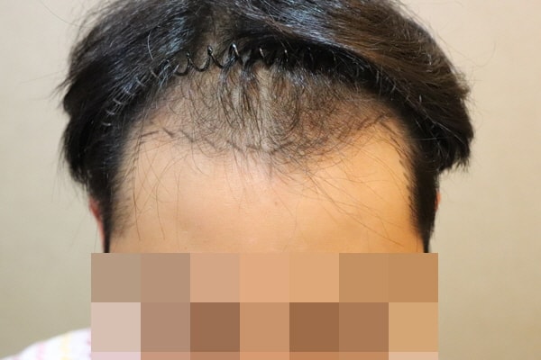 JP성형외과 비절개 모발이식 1년차 후기