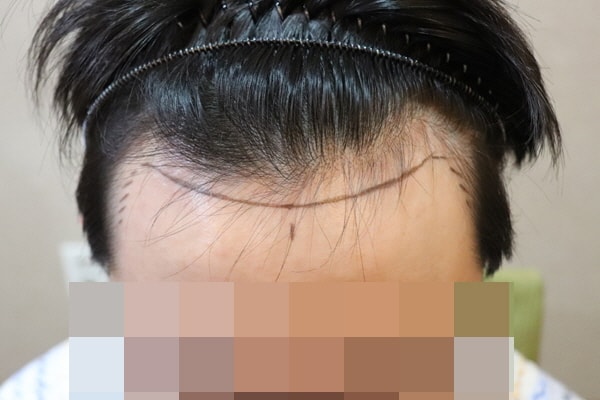 jp성형외과비절개 2주차 후기올려봅니다