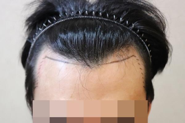 jp성형외과에서 비절개 모발이식받았습니다